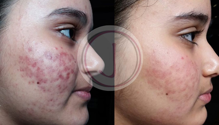 Acne scar treatment results