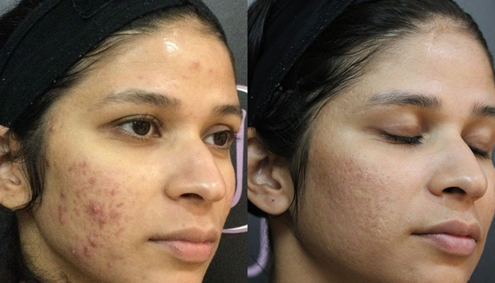 Acne scar removal results