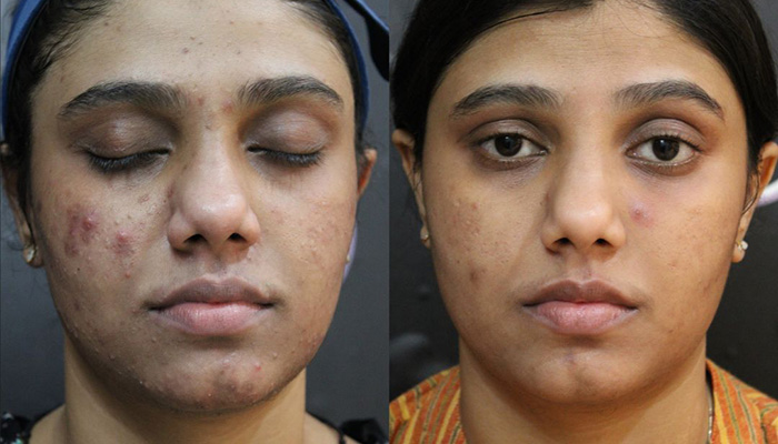 Before and after acne scar treatment