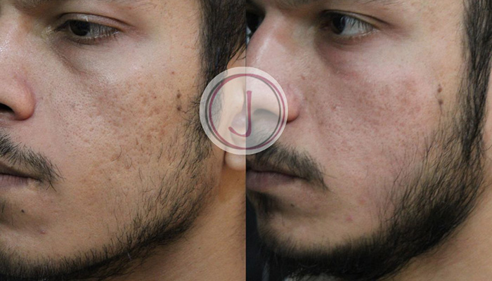 Acne scar improvement