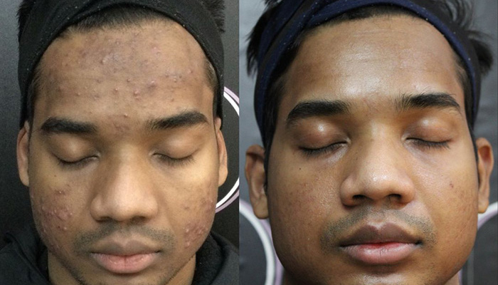 Clear skin after acne scar treatment