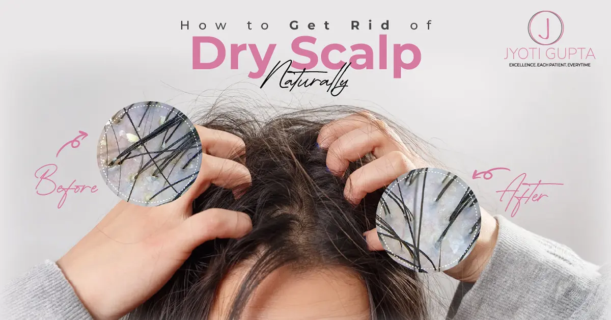 How to Get Rid of Dry Scalp Naturally