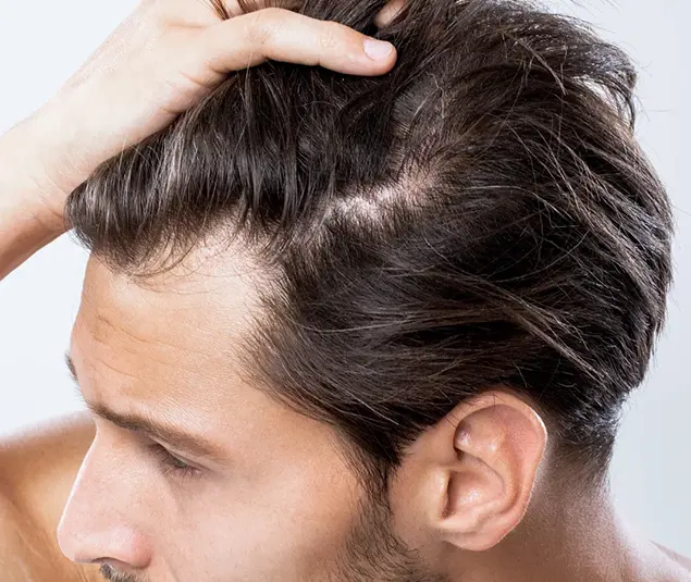 Advanced Regenera Hair Therapy in South Delhi