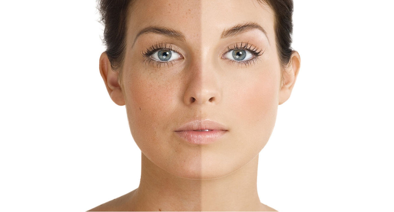 Pigmentation Treatment in Delhi